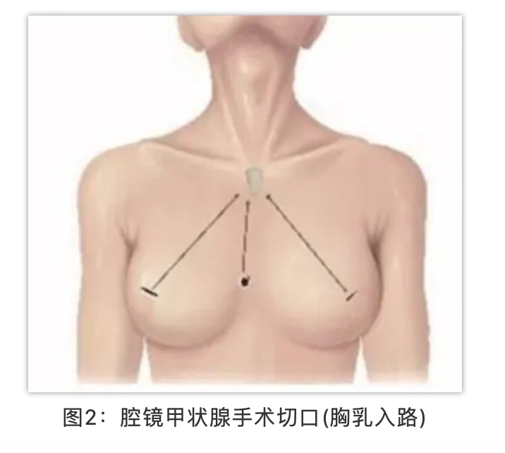 甲状腺外科手术,脖子上可以做到"零"疤痕