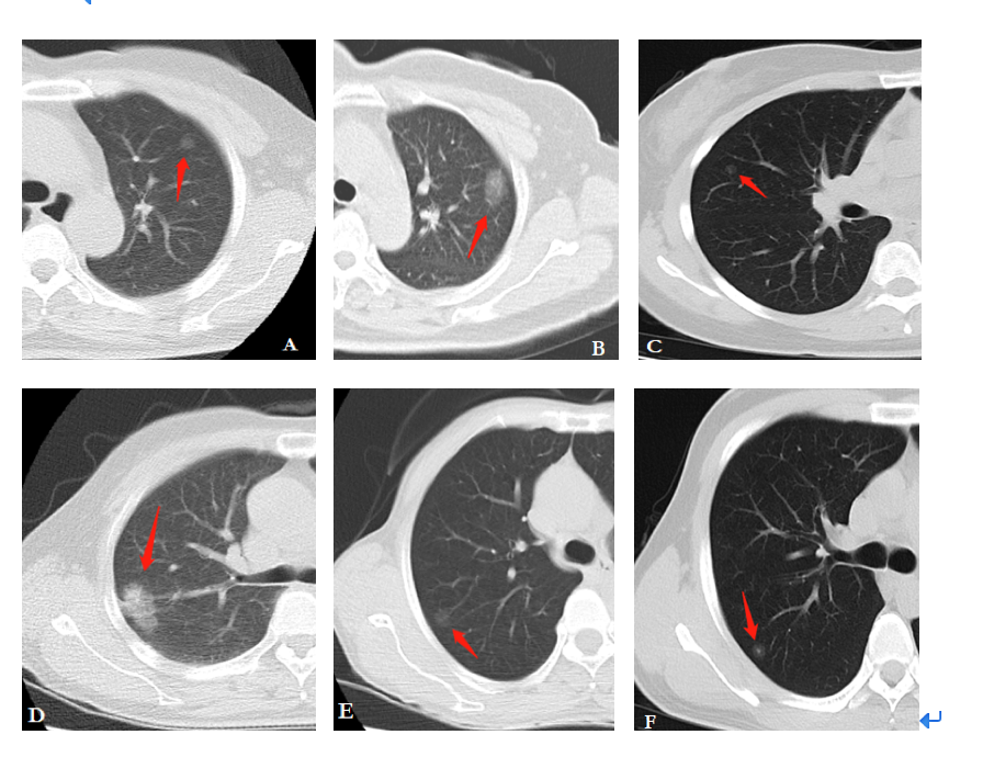 肺癌诊断证明图片图片
