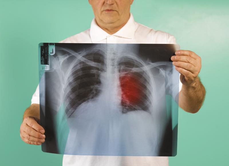 肺癌晚期ct报告单图片图片