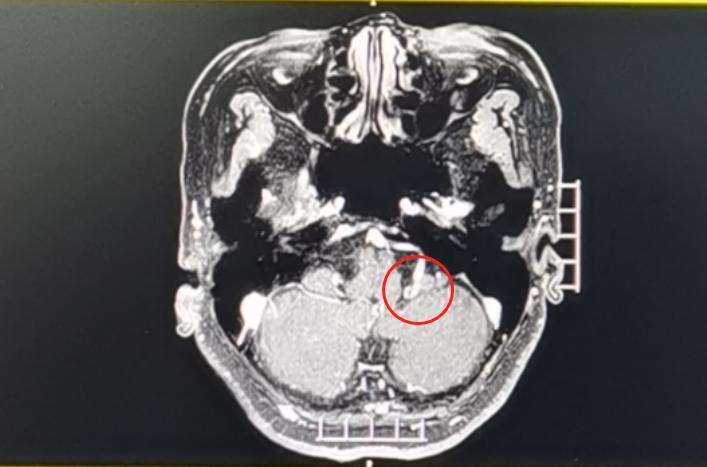 术前头颅MRI显示:左侧面神经根部有明显的血管压迫.jpg