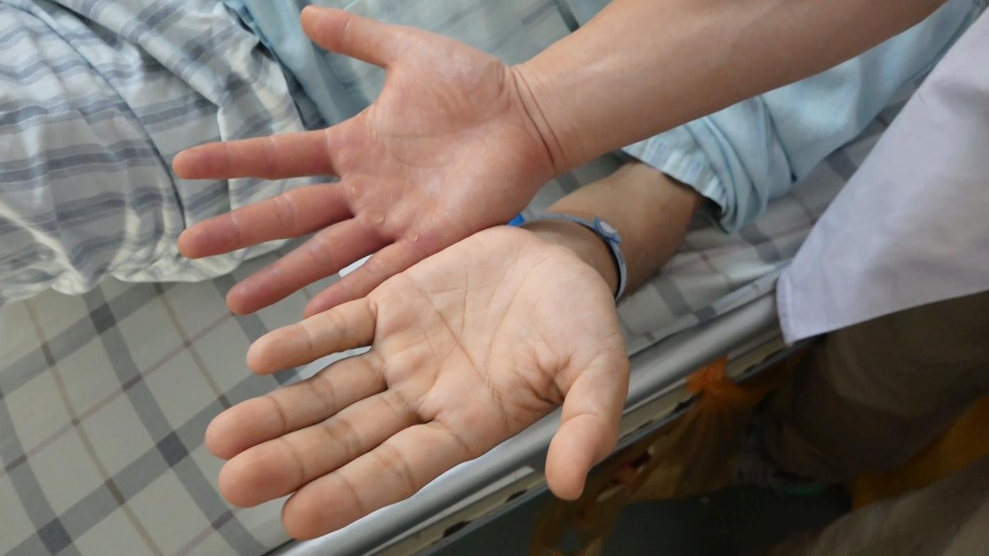 患者的手（下）与医生的手（上）对比.jpg
