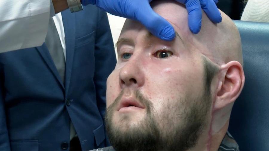 全球首例全眼移植手术：失去的眼睛为何难以新生？角膜移植后的又一次“革命”