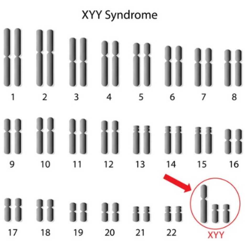 超雄综合征患者还能正常生育？怀了超雄综合征的宝宝该怎么办？专家解析→